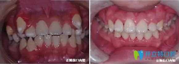 杭州美奧口腔給兒童做的牙齒矯正前后效果