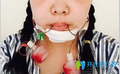 我做正頜手術的當天照