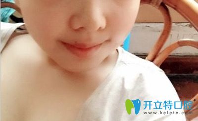 廣大口腔何錦泉醫(yī)生給做完正頜手術4個月效果