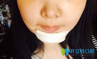 做正頜手術半月后效果圖