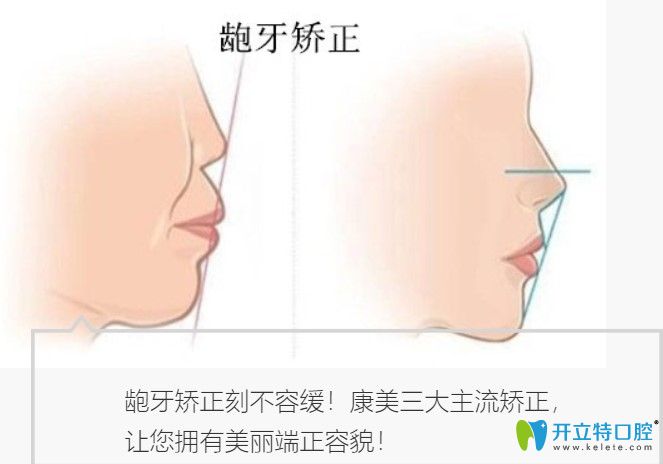 <!--<i data=20240703-sp></i>-->口腔齙牙矯正的方式