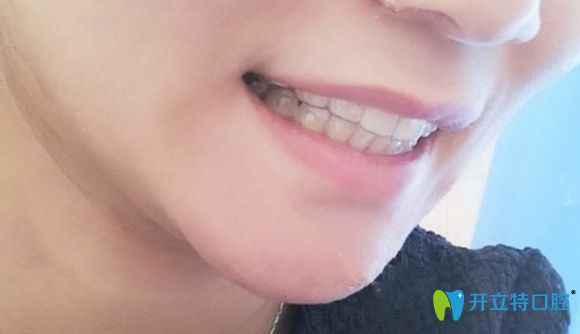 在北京美萊口腔戴隱形牙套18個(gè)月的矯正效果圖