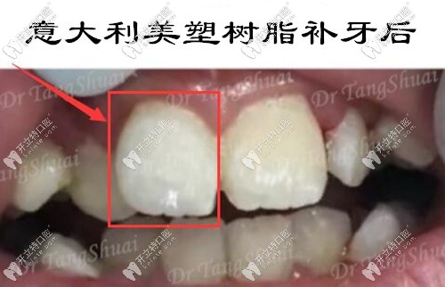 用意大利美塑樹脂材料補(bǔ)牙后
