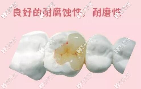 嵌體補(bǔ)牙