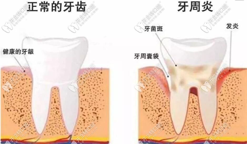 牙周炎的表現(xiàn)