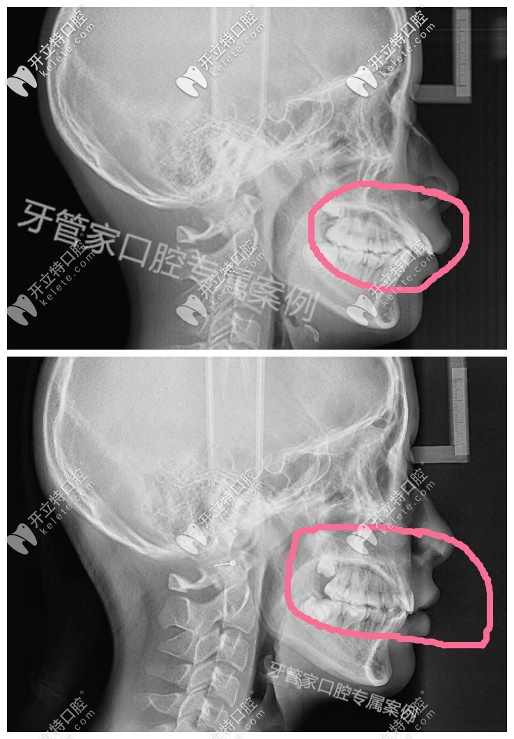 骨性齙牙帶牙套有效果，下牙套后我的骨性牙齒內(nèi)收了6毫米
