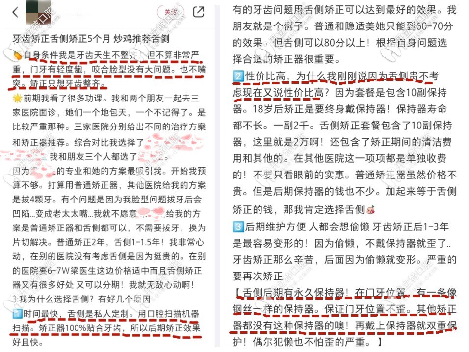 舌側(cè)隱形矯正親身經(jīng)歷者評(píng)價(jià)