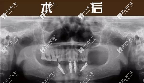 下半口做完4顆種植牙的全景片圖