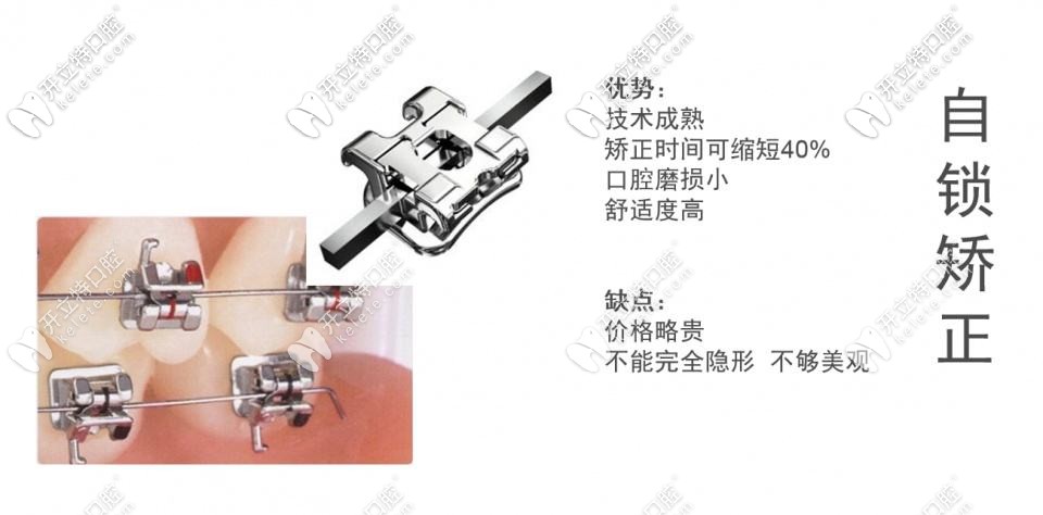 銀川做牙齒矯正大概需要多少錢(qián)?去哪家做正畸要好一點(diǎn)