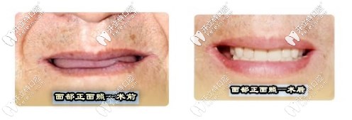 面部正面照術前術后對比 面部正面照術前術后對比