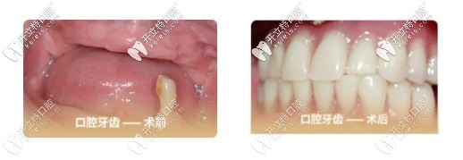 我75歲沒牙去做了全口all-on-4種植牙的經(jīng)歷，種牙過程很快