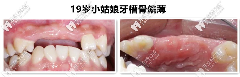牙槽骨不足，需要植入骨粉