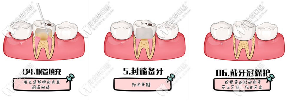 根管治療過程