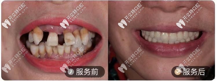 50歲阿姨，做的ALL-ON-4種植牙對比圖