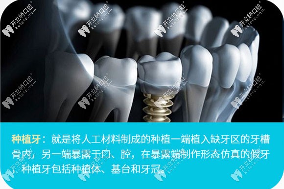 在我們廣州新塘華醫(yī)口腔做一顆韓國登騰種植牙花了7千多元