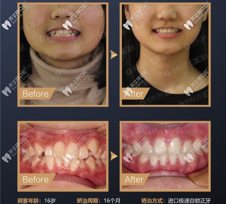 費露醫(yī)生的正畸案例