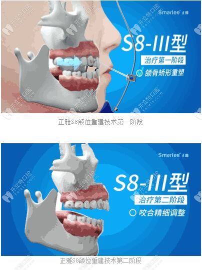 正雅S8、S9、S10頜位重建術(shù)