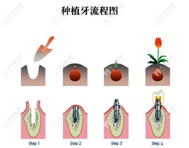 種植牙流程圖解